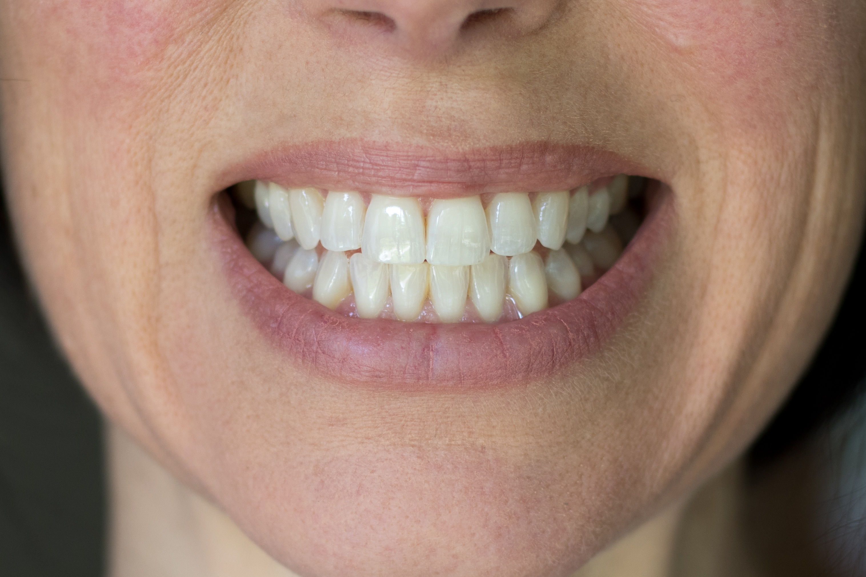 smile-brilliant-teeth-whitening-kit